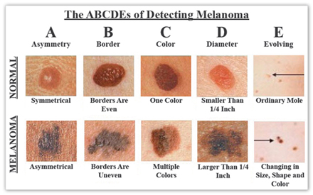 Melanomas