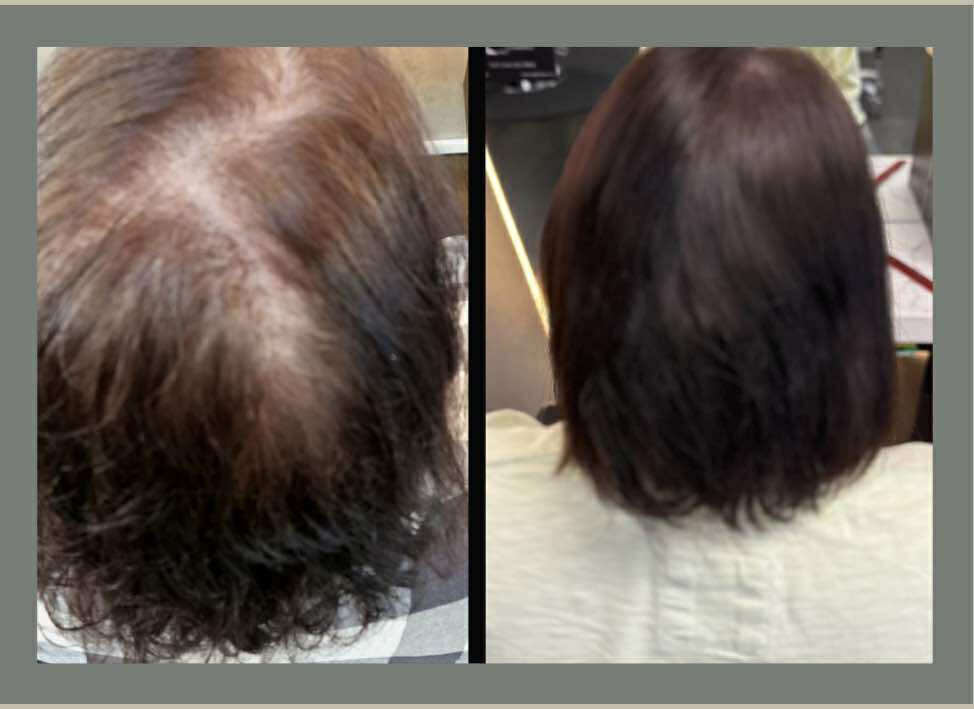 scalp micropigmentation before and after